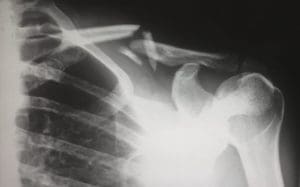 X ray of a broken bone