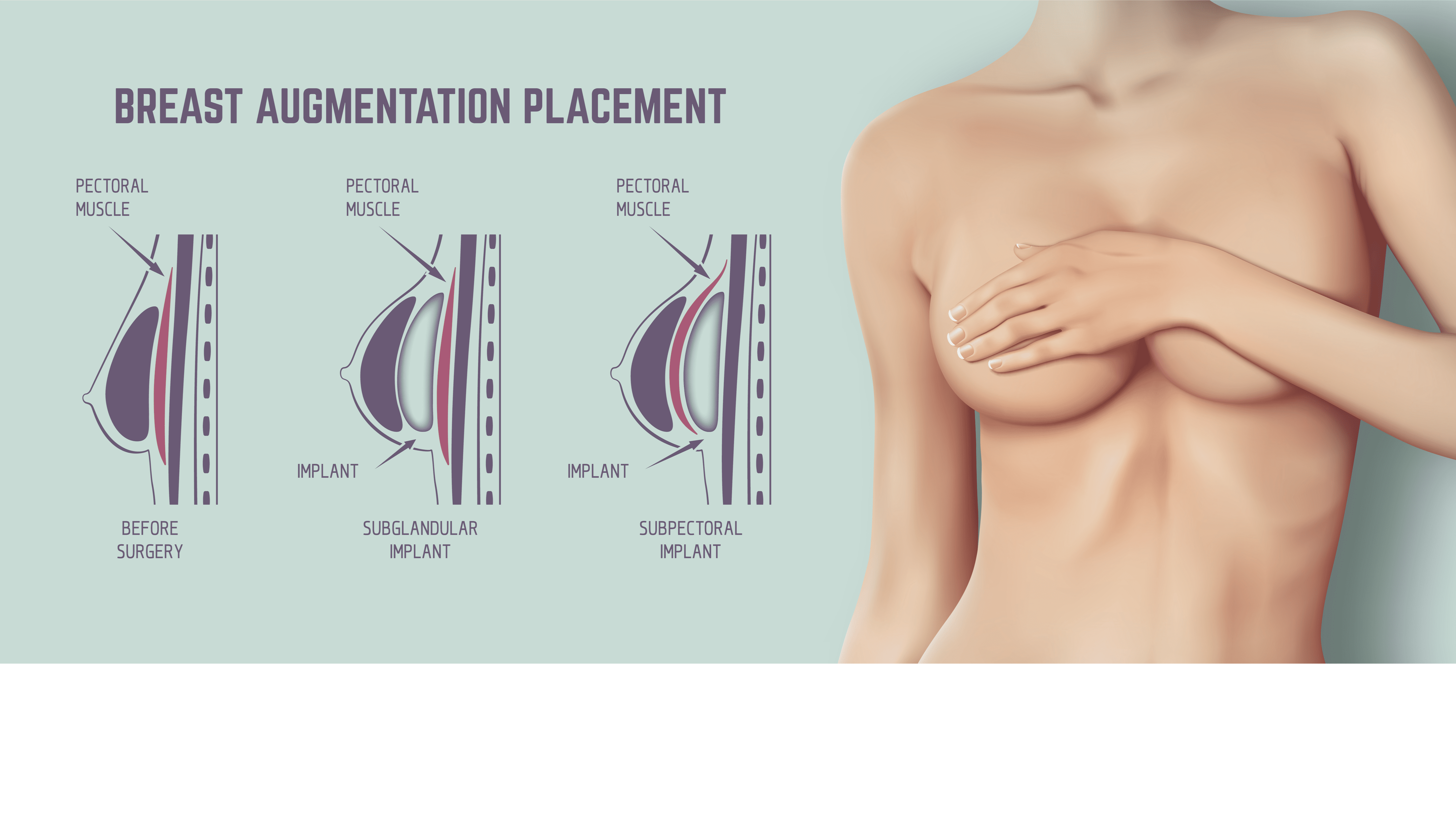 breast implants