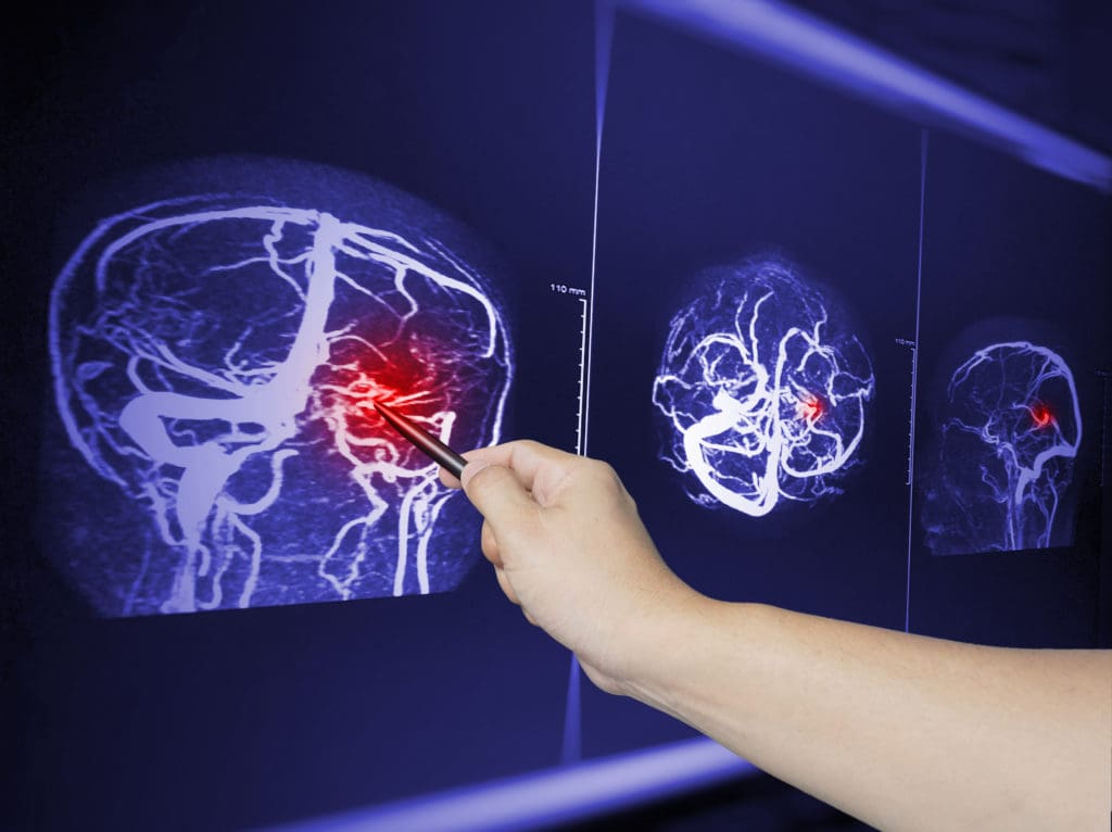 traumatic brain injury or TBI shown on MRI