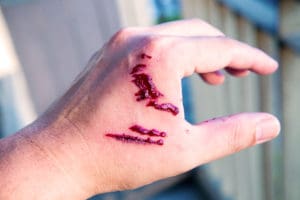 injury from dog bites