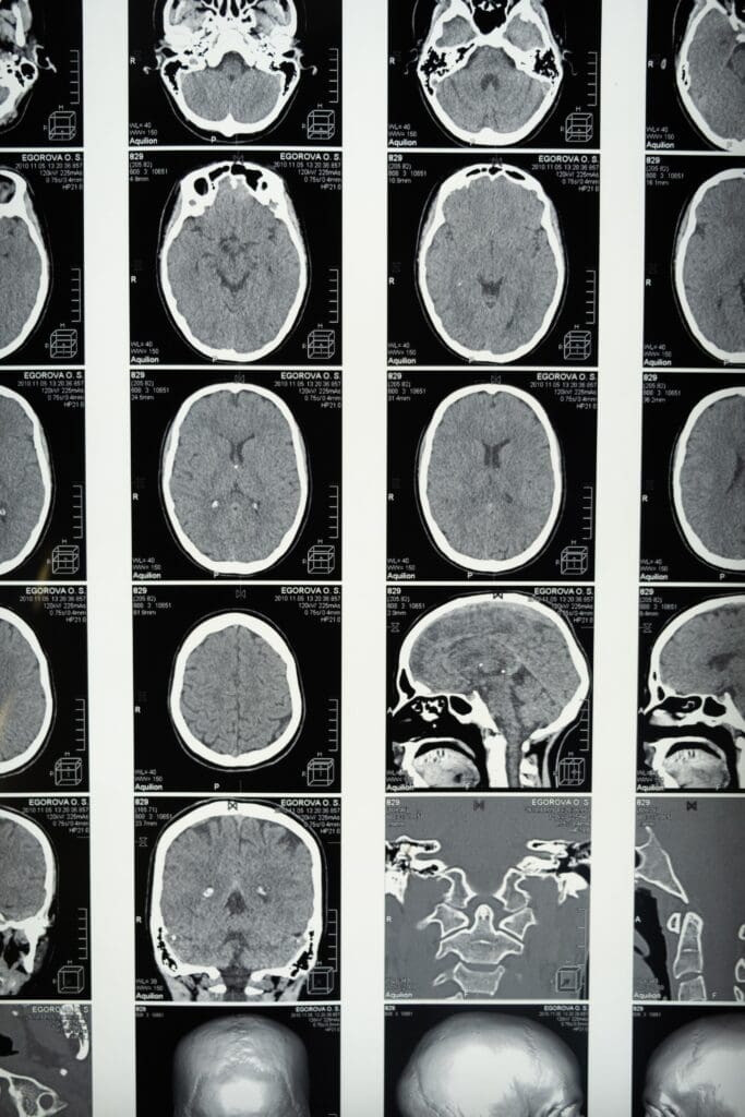 Lesiones cerebrales en Alexandria