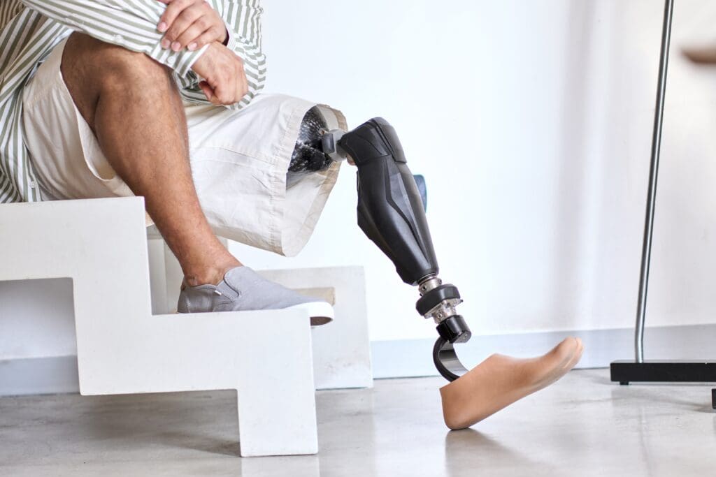 Herndon amputation injury attorney