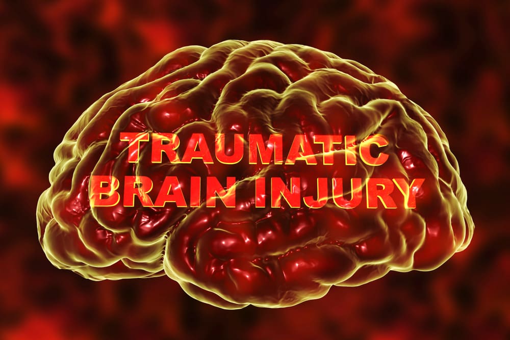 Cap Springs TBI Lawyer