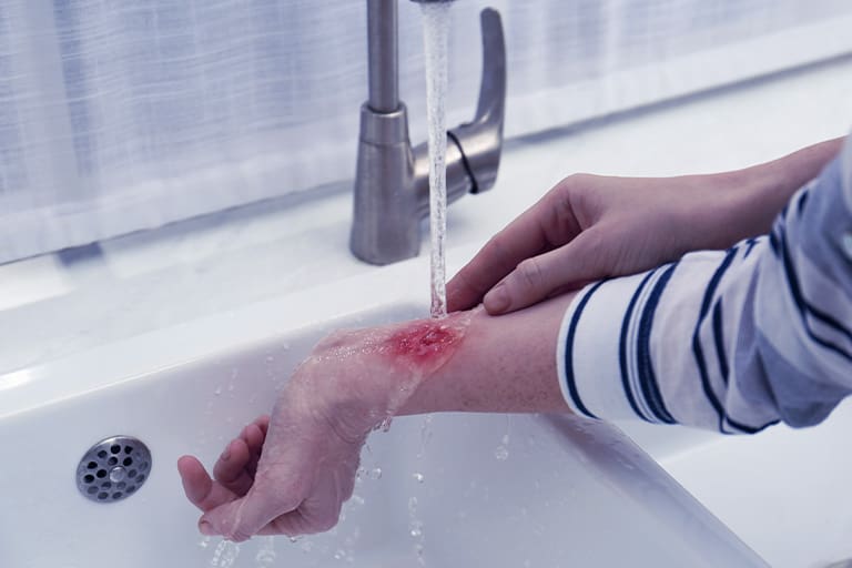 Workers’ Comp Burn Injuries